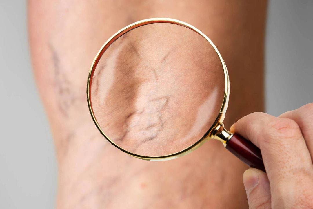 Tratamento de Microvasos